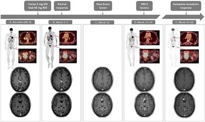 Successful treatment of MAP2K1 mutant stage IV-M1d melanoma with trametinib plus low-dose dabrafenib: a case report